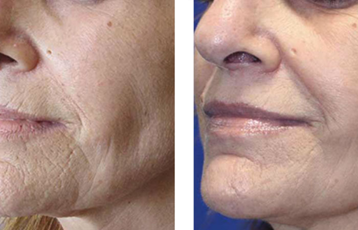 احیا و جوانسازی پوست