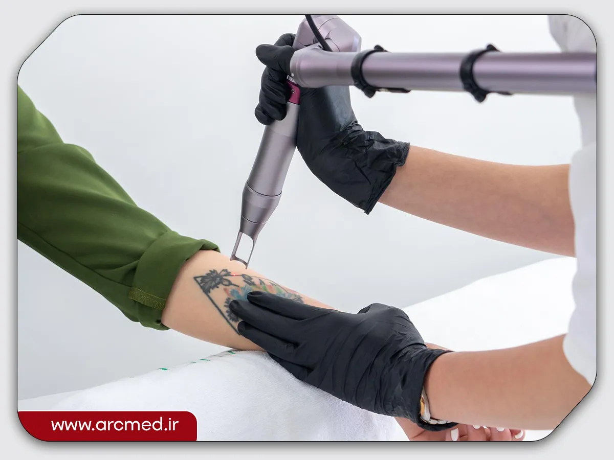 حذف تتو با لیزر الکساندرایت