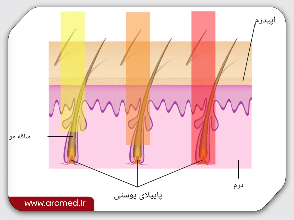 دستگاه لیزر تیتانیوم 3 دستگاه لیزر تیتانیوم