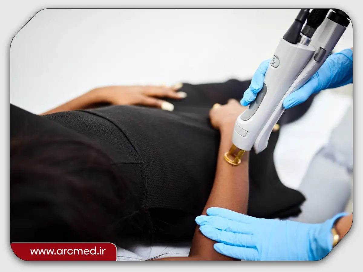 لیزر موهای زائد