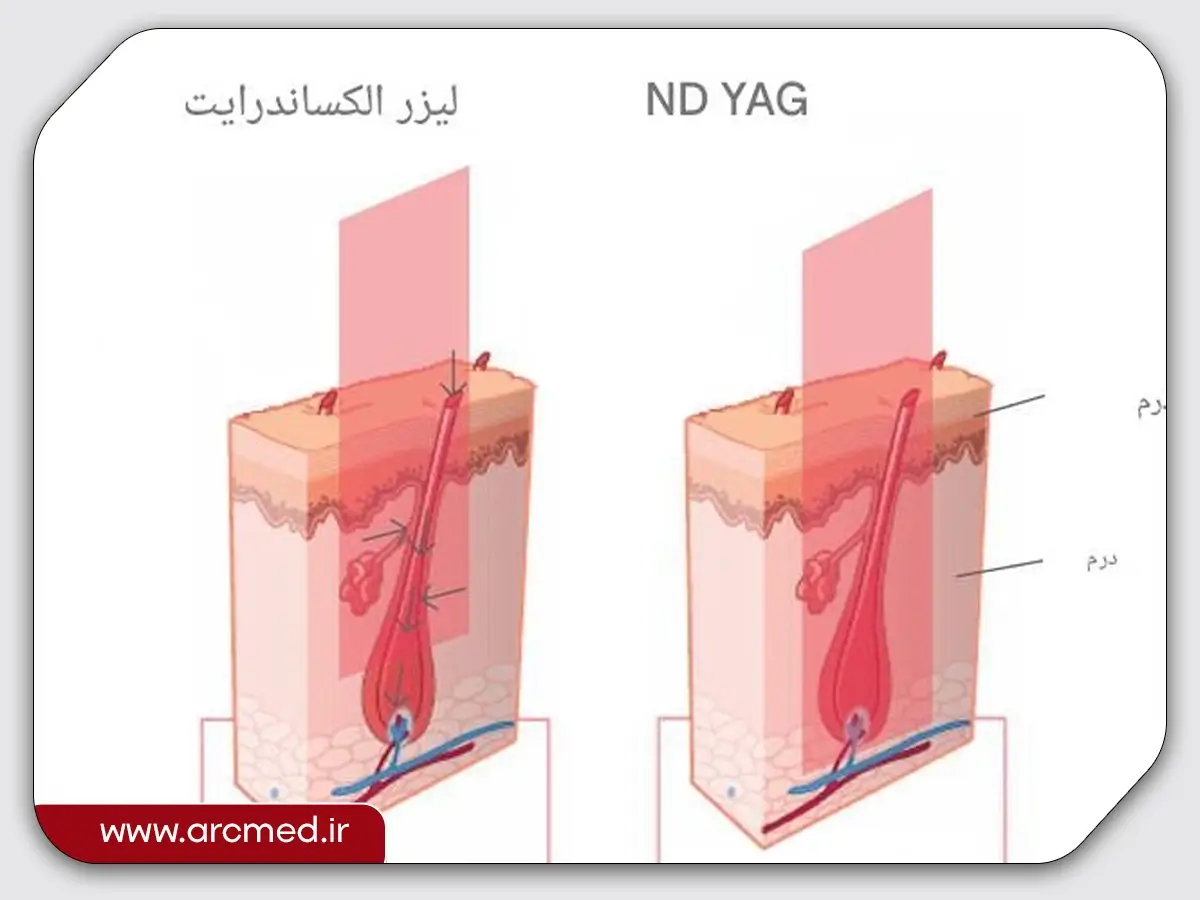 دستپاه لیزر ان دی یاگ و الکساندرایت