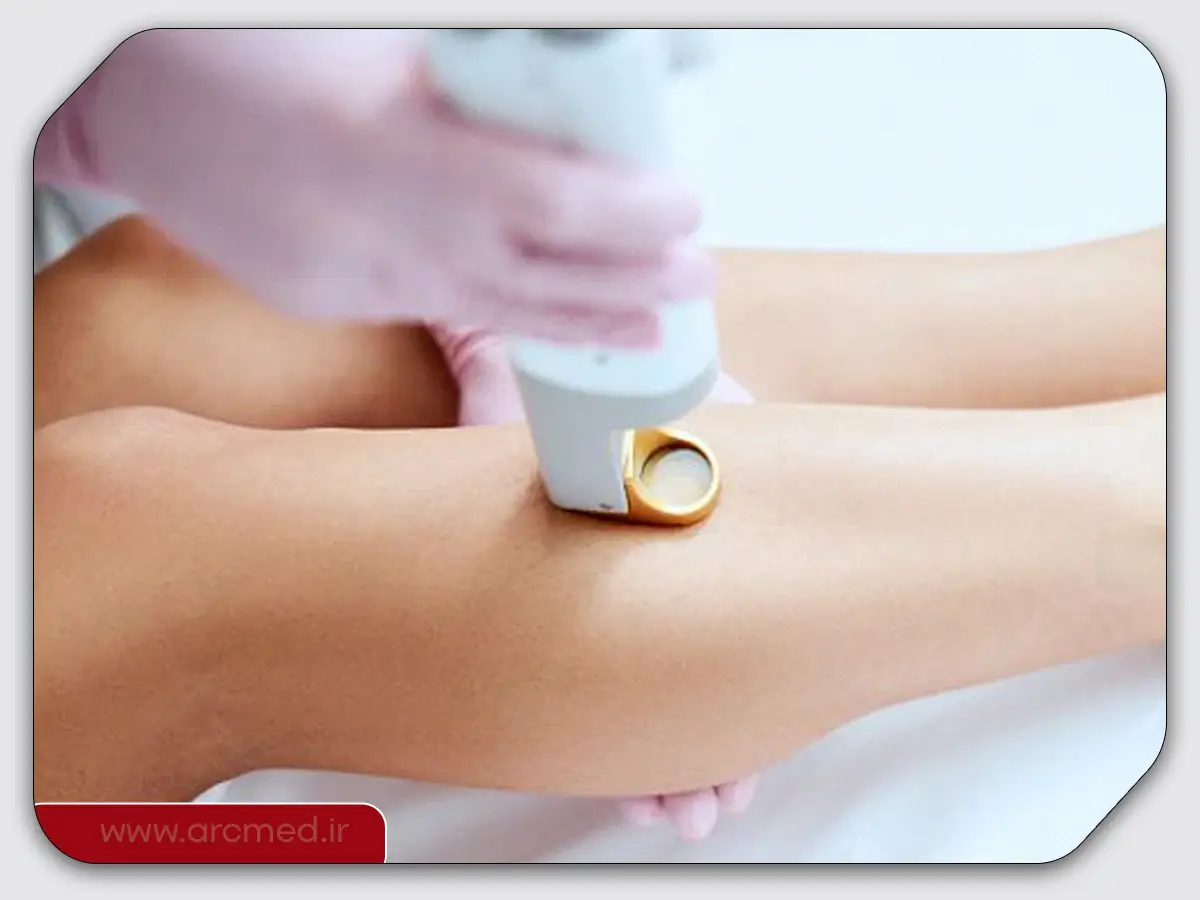 بهترین دستگاه لیزر موهای زائد برای پوست روشن 3 لیزر موهای زائد پوست روشن